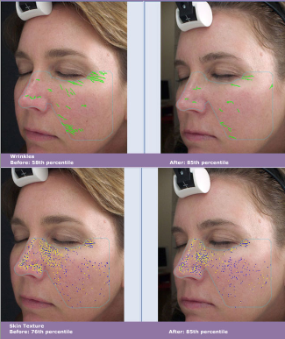 stock before and after images of VISIA Complexion Analysis System