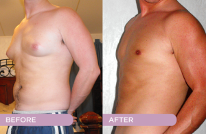 Gynecomastia Patient from Pope Plastic Surgery
