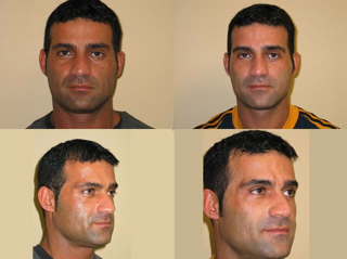 before and after image of blepharoplasty for blog post